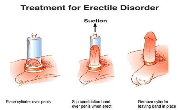 Máy tập tăng kích thước dương vật hiệu quả bảo hành chính hãng
