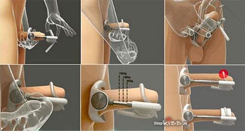 Dụng cụ kéo dài dương vật Pro Extender ABS kim loại nhập Mỹ chất lượng