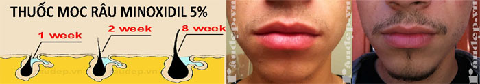 Minoxidil 5% Dạng Bọt Tăng Mọc Râu Mạnh Mẽ, Hiệu Quả